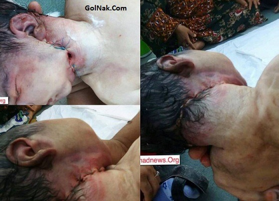 ماجرای کامل جدا شدن سر نوزاد هنگام تولد در ایرانشهر چه بود + عکس
