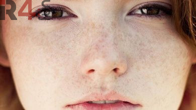 درمان لکه های پوستی با روش خانگی