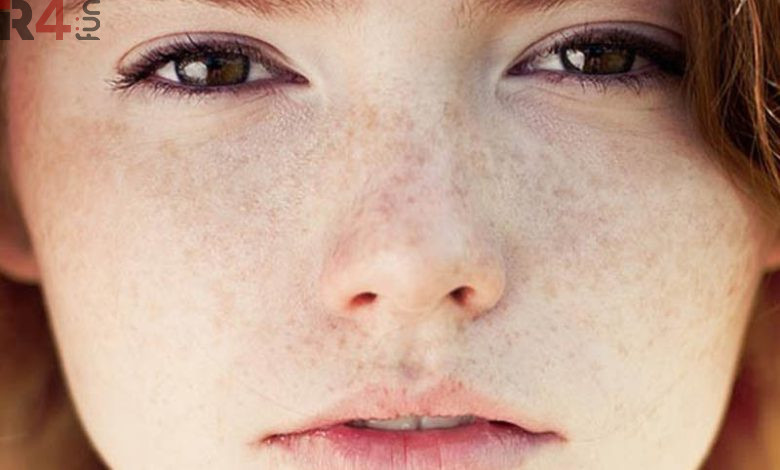 درمان لکه های پوستی با روش خانگی