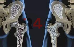 برای پیشگیری از پوکی استخوان و درمانش چه کار کنیم؟ + فیلم –   ایران فورفان