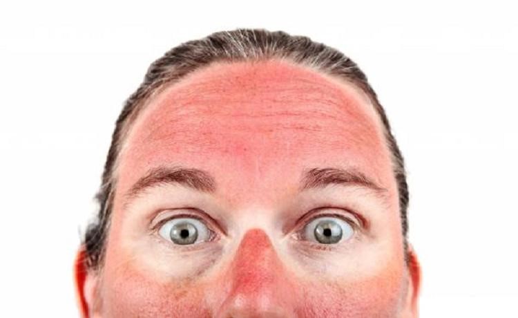 لکه های پوستی ناشی از آفتاب سوختگی