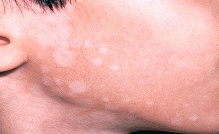 درمان لکه های سفید پوست با رتینول