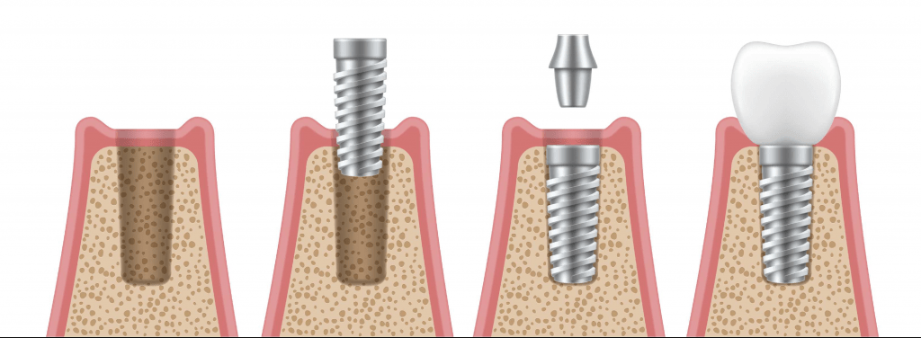 ایمپلنت دندان چگونه انجام می شود ؟