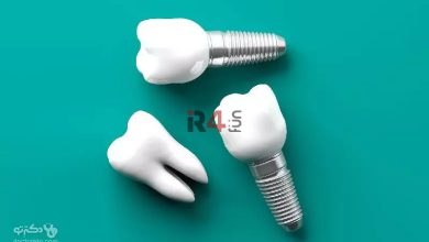 بهترین ارائه دهندگان ایمپلنت دندان با قیمت و هزینه مناسب + تخفیف در دکترتو کلینیک –   ایران فورفان